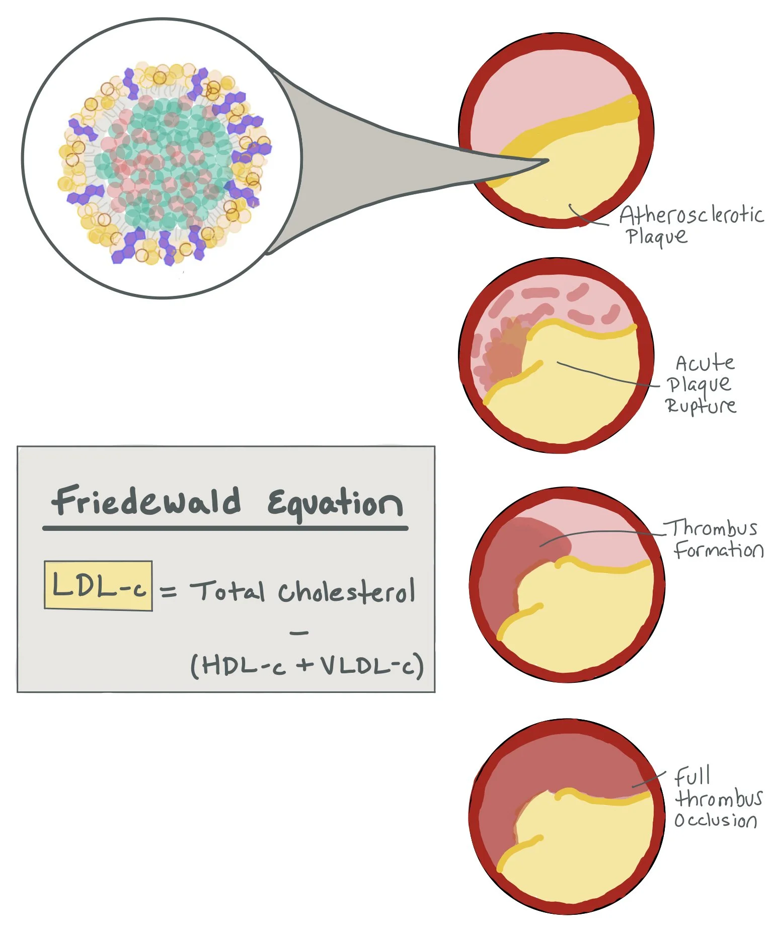 Lipids in Primary and Secondary Prevention — When the Beat Drops